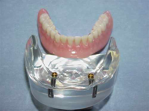 Tijuana Dentist Overdenture