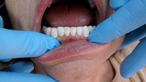 Tijuana Dentist Sirconia Full Bridge Down - After